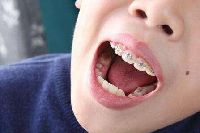 【健康解碼】矯正牙齒真的可以瘦臉嗎？